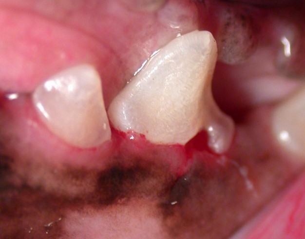 tooth resorption