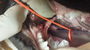 Operculectomy performed on the impacted right lower third molar.