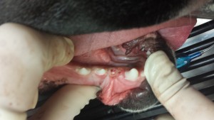 Operculectomy performed on the soft tissue impacted right lower first premolar.