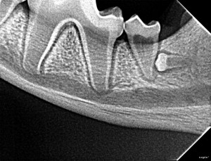 Bole left lower molar 3