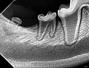 Shallow right lower third molar.