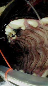 Small tumor hidden between the molars.